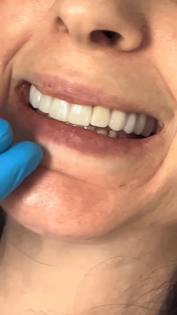 Close-up of a person's smile showing their teeth, with a gloved hand touching the cheek.