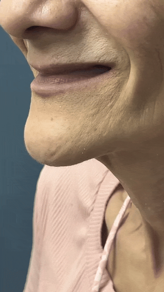 dentures