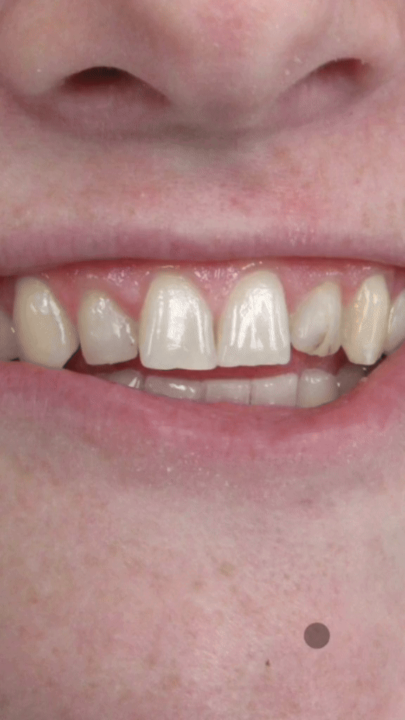 veneers, cosmetic dentistry