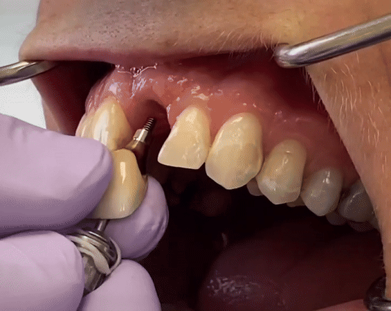 dental implants, cospetic dentistry