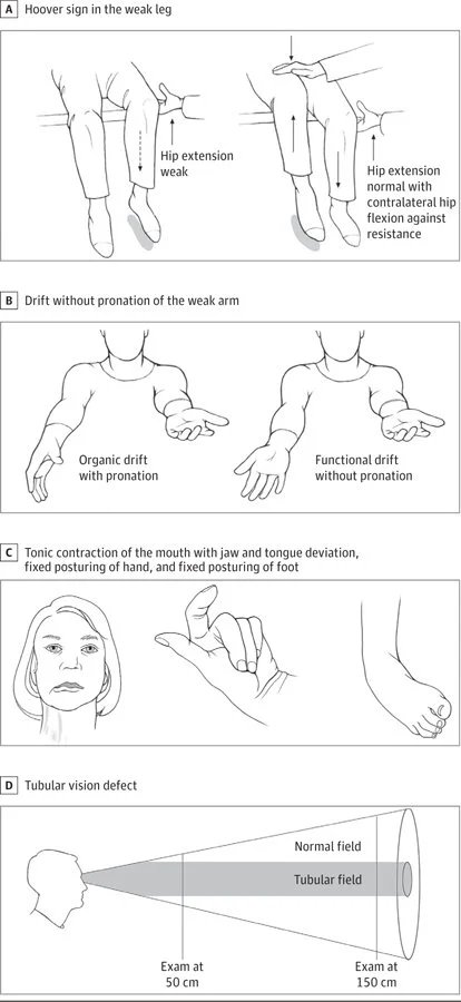 Image from Espay et al. (2018) demonstrating classic tests for functional neurological disorder.