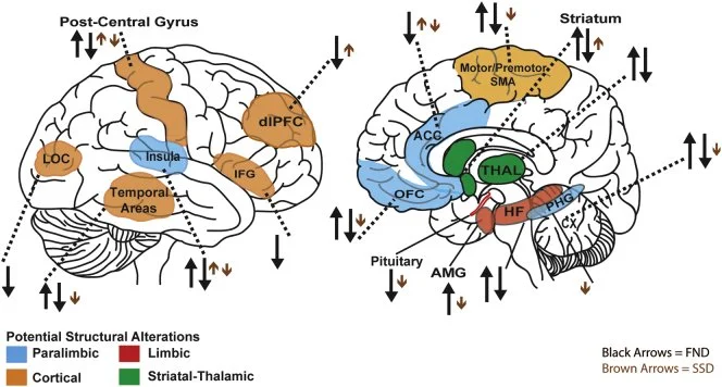 Brain mapping displaying increased, or decreased, brain activation for functional neurological disorders and somatic disoders.