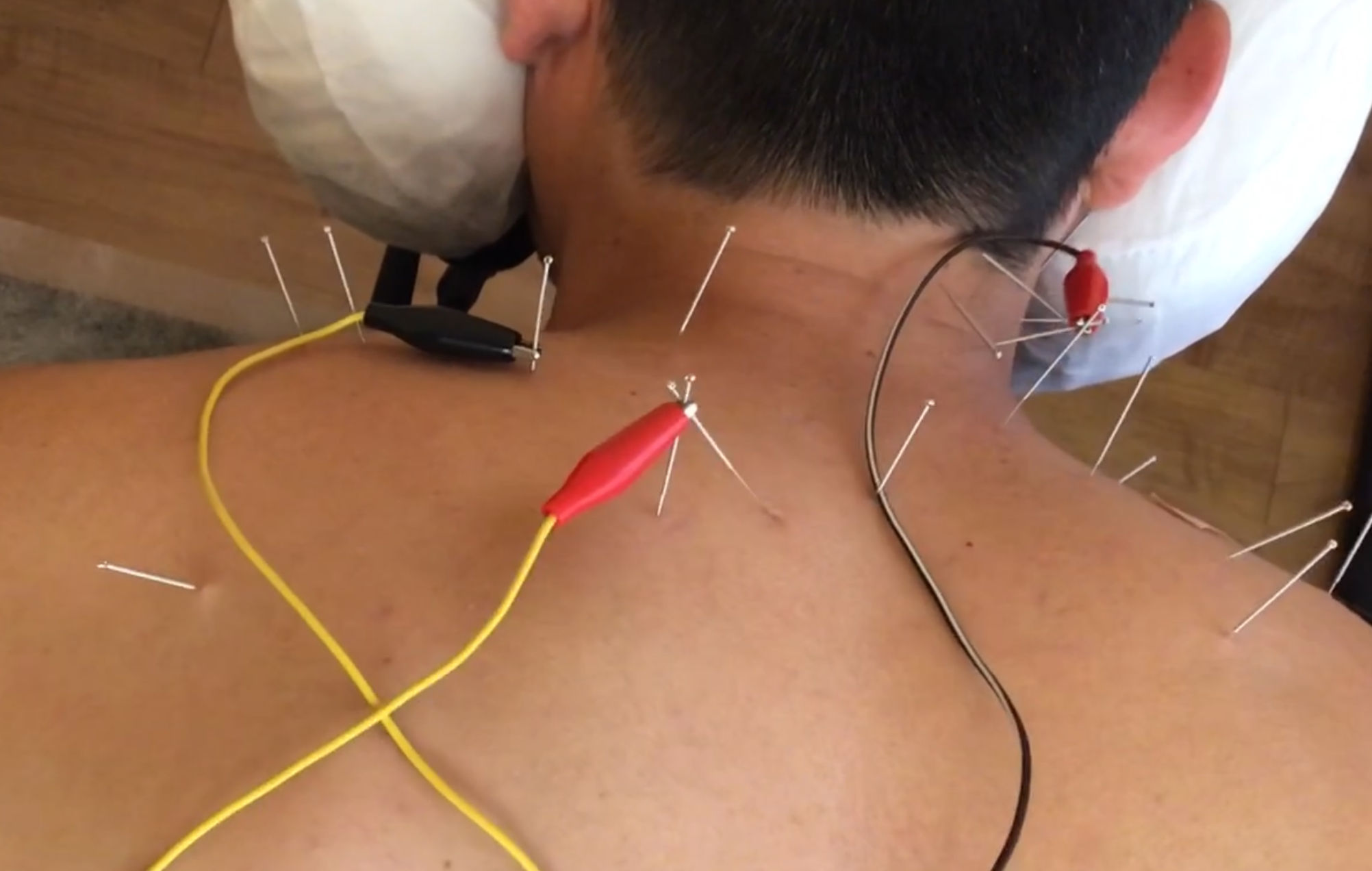 Precision Dry Needling Level 2