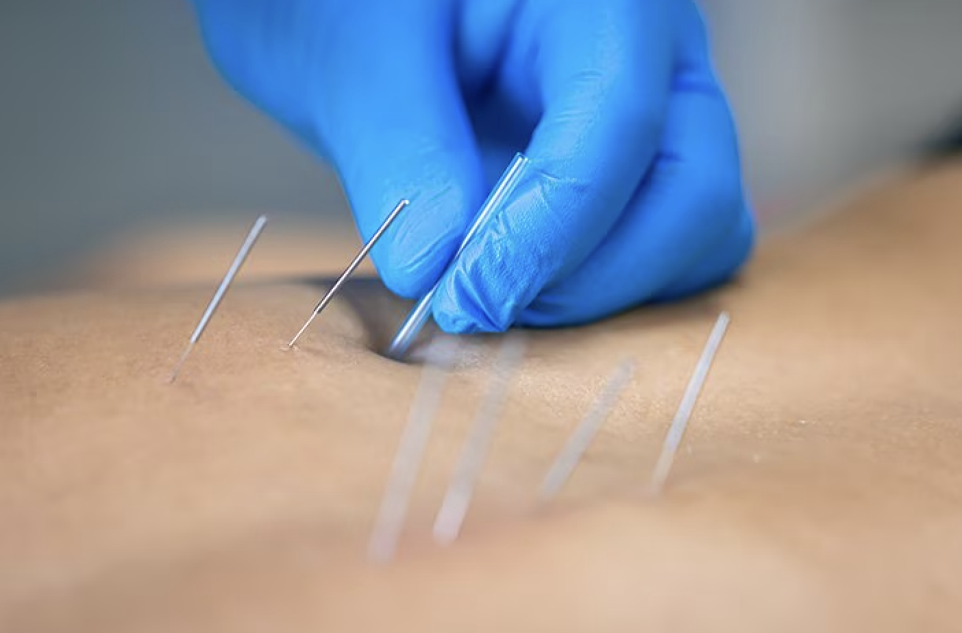 Precision Dry Needling Level 1