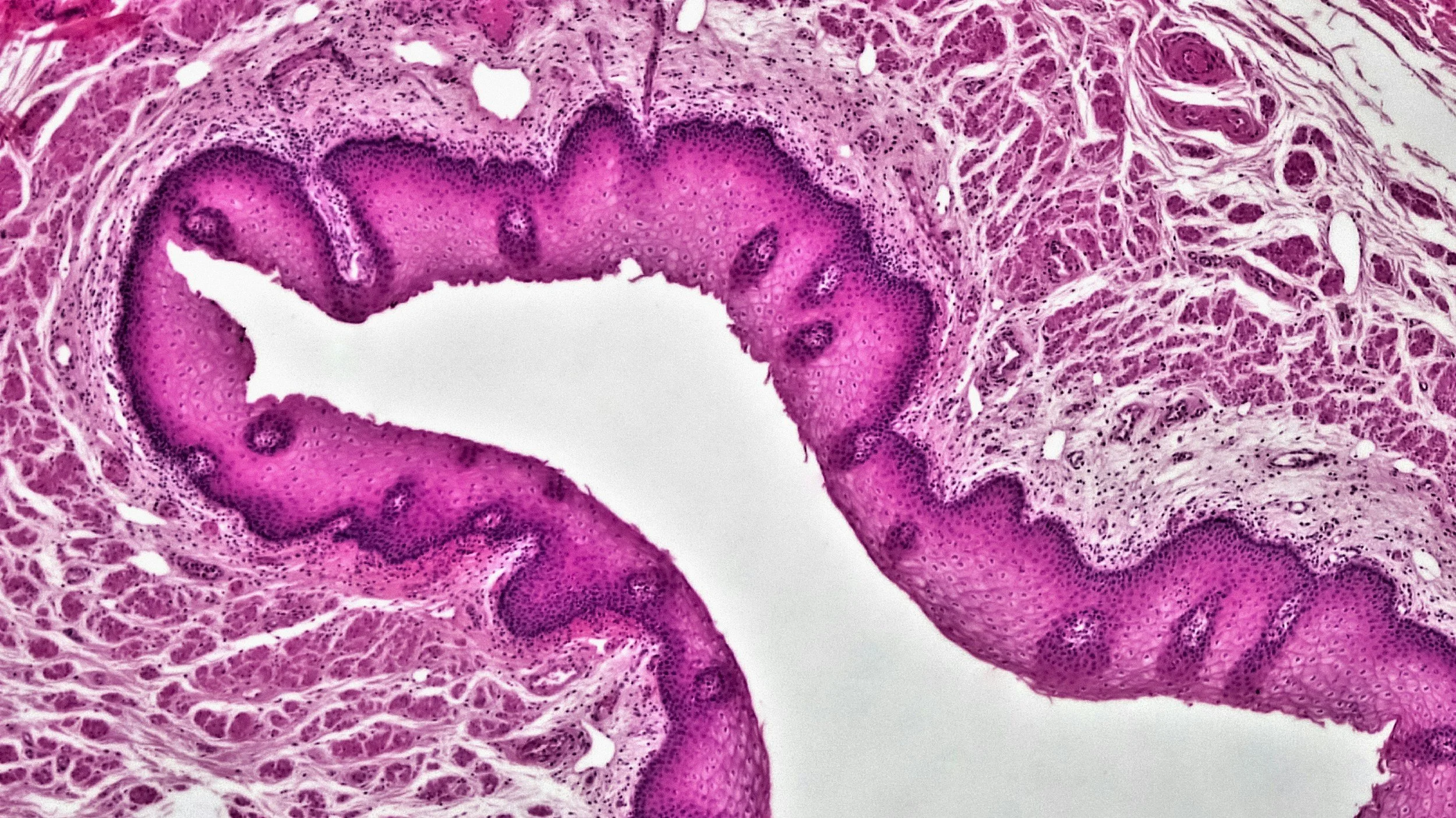 Acid Reflux and Heartburn: Why Antacids Are Not the Answer and What to Do Instead