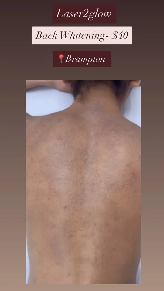 Back whitening- $40
📍Brampton
Dm or call (647-390-0046) to book an appointment
#fyp #whitening #brampton #backrenewal #toronto #skincare