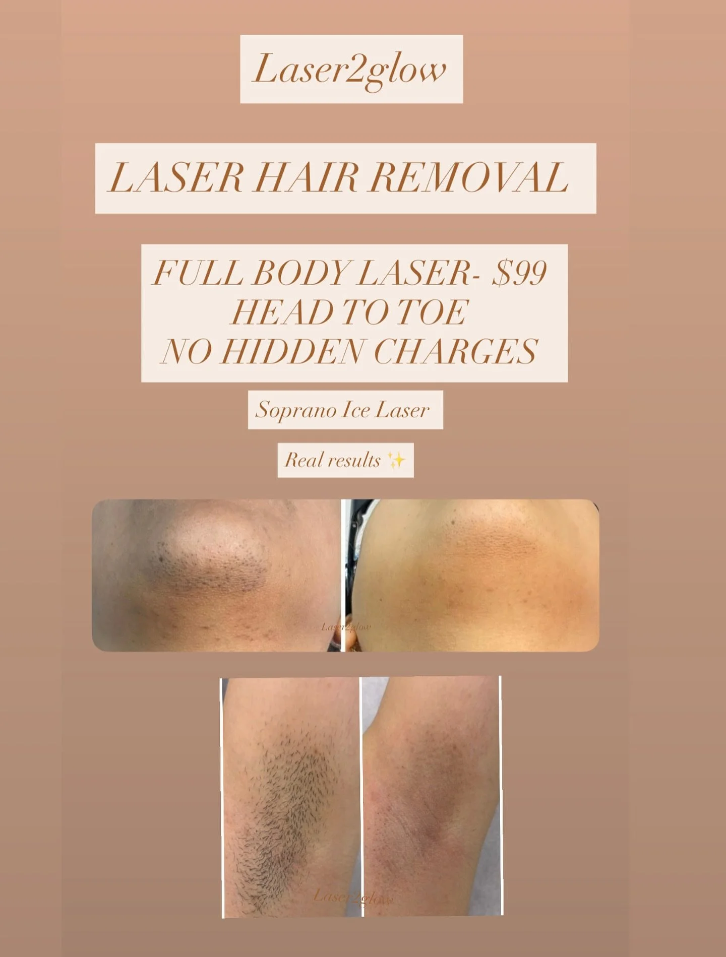 Full body laser (head to toe)- $99
Dm or call (647-390-0046) to book an appointment.
#fyp #laserhairremoval #brampton #toronto