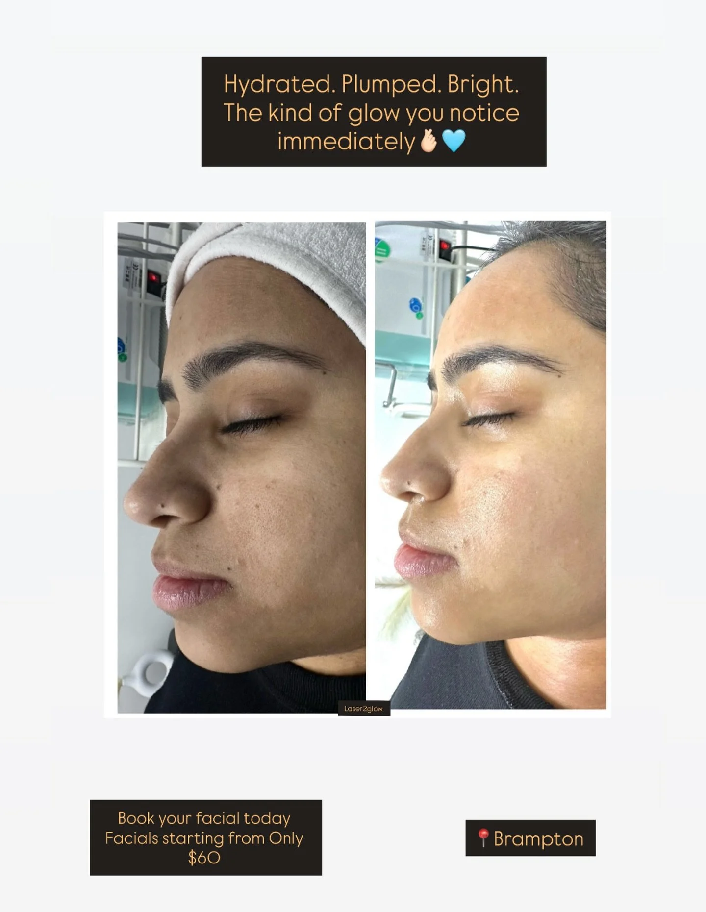 Skin feels like it can finally breathe. That fresh, hydrated, glassy glow,Right after one session 🩵✨
Book your facial today ✨

#fyp #skincare #facial #brampton #toronto