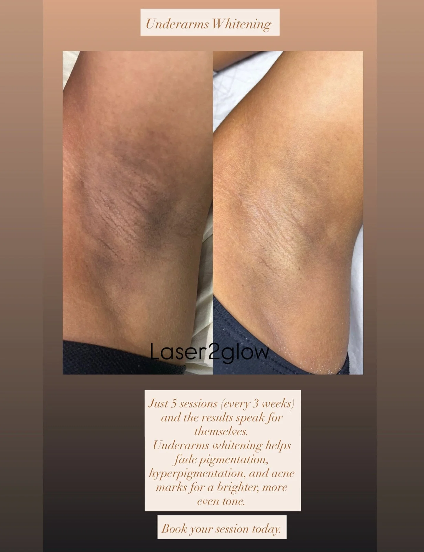 Underarms whitening - $40 

Benefits:-

	&bull;	Brightens pigmentation &amp; hyperpigmentation for a more even tone
	&bull;	Helps fade marks and acne scars (post-acne discoloration)
	&bull;	Smoother-looking skin texture and a more &ldquo;clean&rdquo;