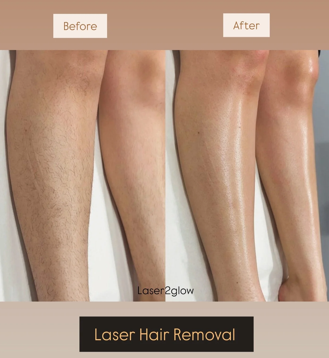 Smooth legs aren&rsquo;t a &ldquo;someday&rdquo; thing&mdash;this is just 4 sessions. Start your laser journey this winter. Book your session now ✨

#fyp #laserhairremoval #brampton #mississauga #sopranoice