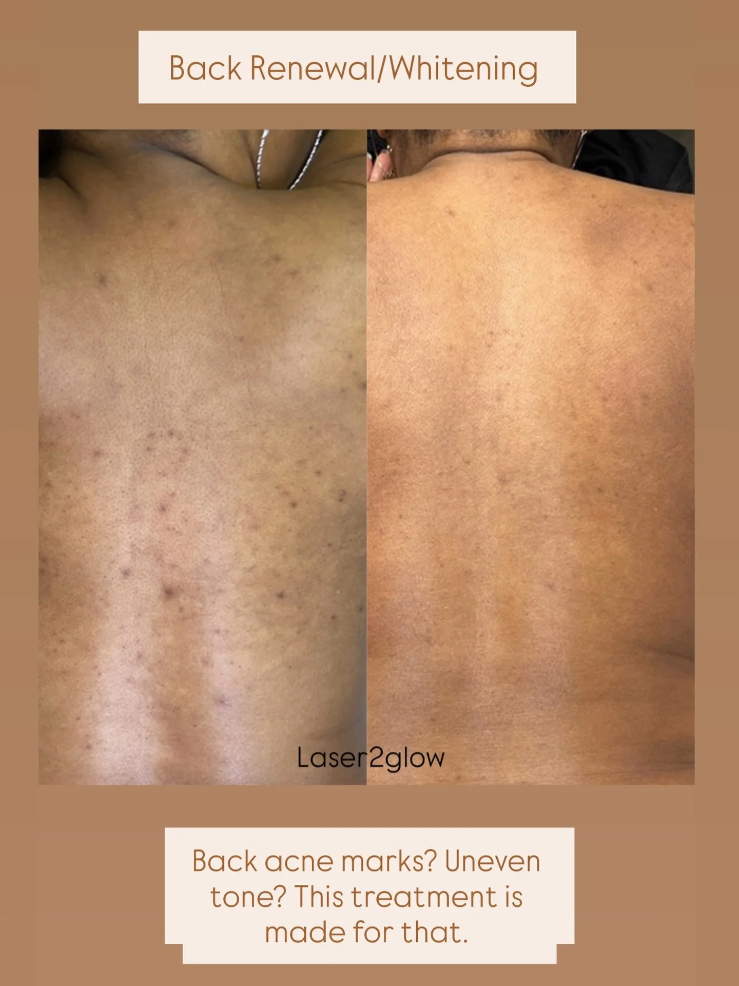 Because your back deserves skincare too.
Back Whitening- $40
📍Brampton 

#fyp #backwhitening #skincare #brampton #toronto