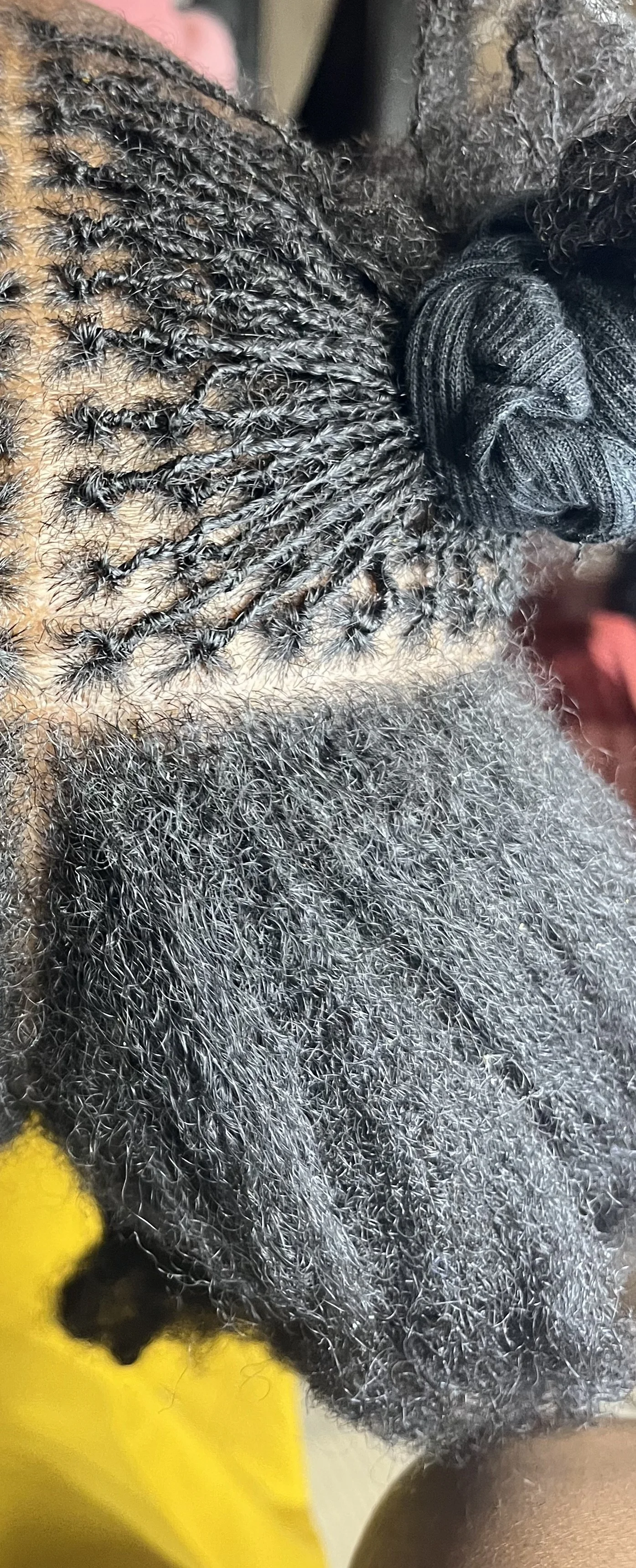 Close-up of a person's while receiving a microlocks establishment.