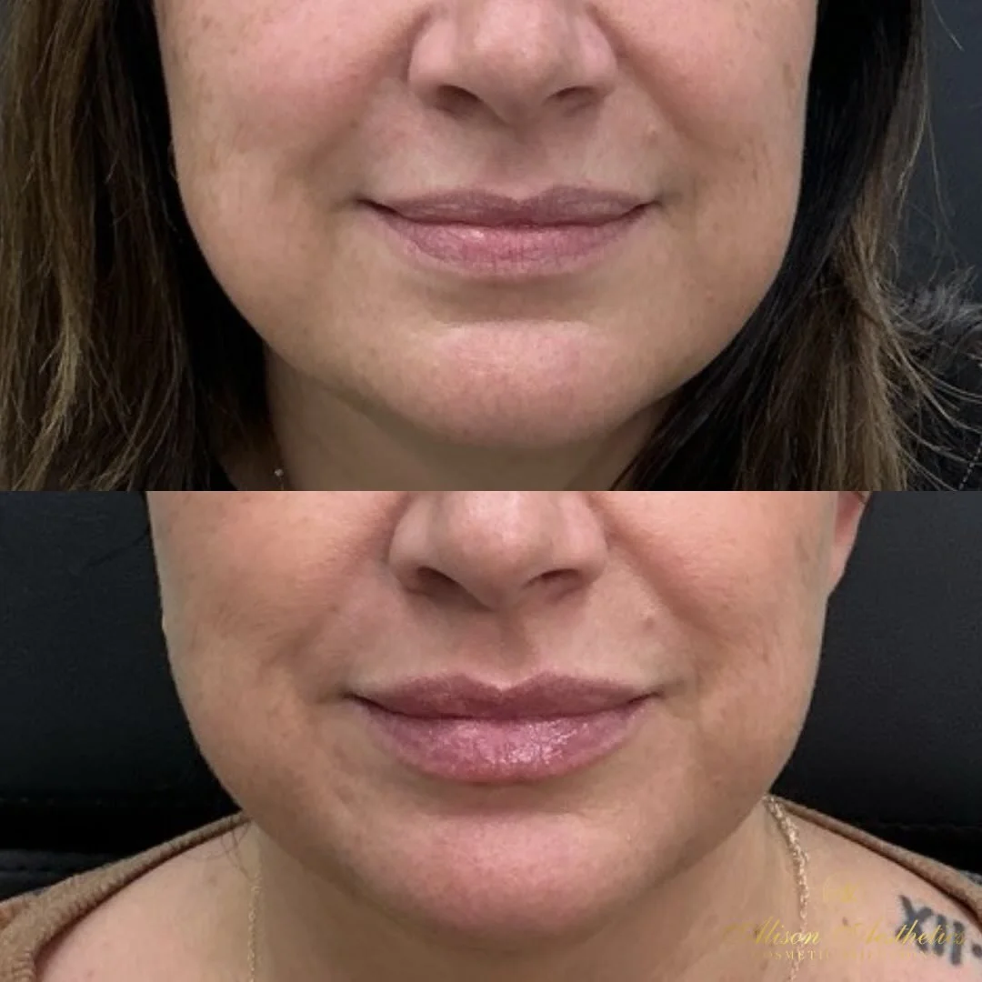 Natural doesn&rsquo;t mean &ldquo;nothing was done.&rdquo;

Natural means enhanced in a way that belongs to your features &mdash; and these healed lips by @hannah_alisonaesthetics_ are the perfect example.

Soft volume. Balanced shape. A finish that 