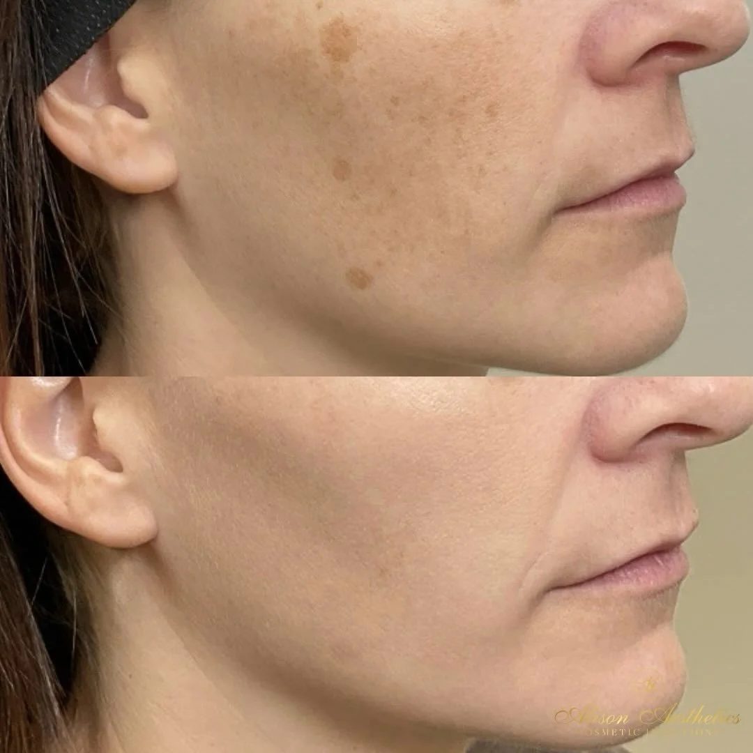 Lumecca season is here, and this transformation by @arikainjects is the perfect example of why we invest in our skin. ⚡️

Lumecca specifically targets excess pigment and visible redness using controlled light energy to help create a clearer, more eve