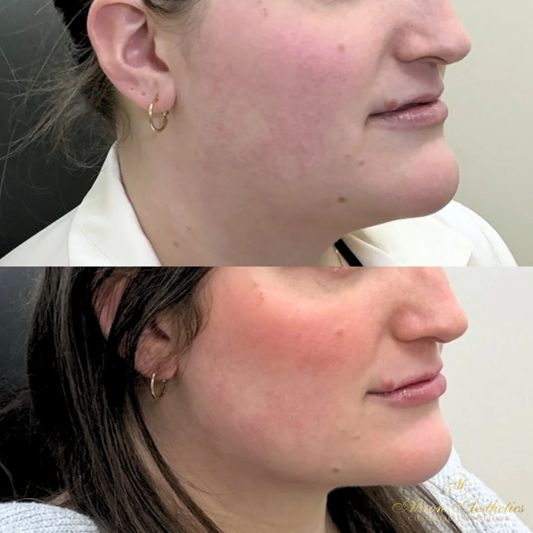 2026 is almost here, and we&rsquo;re focusing on treatments that are always worth it. ✔️

When navigating the aesthetic world, choosing treatments that create true impact matters. One option that isn&rsquo;t talked about enough? Full-face neuromodula