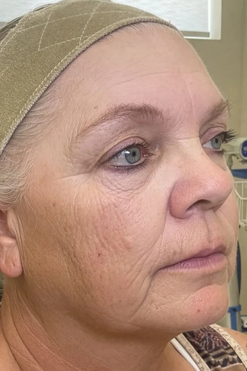 Close-up of an older woman's face with light skin, blue eyes, and signs of aging such as wrinkles and fine lines but this is after Lumecca and the age spots and deep wrinkles are gone.