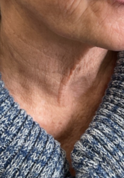 Close-up of a person's neck and lower face, showing skin with wrinkles and a partial view of a blue knitted sweater.