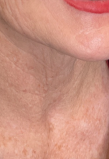 A close-up of a person's lower face and neck, showing skin texture and fine lines.