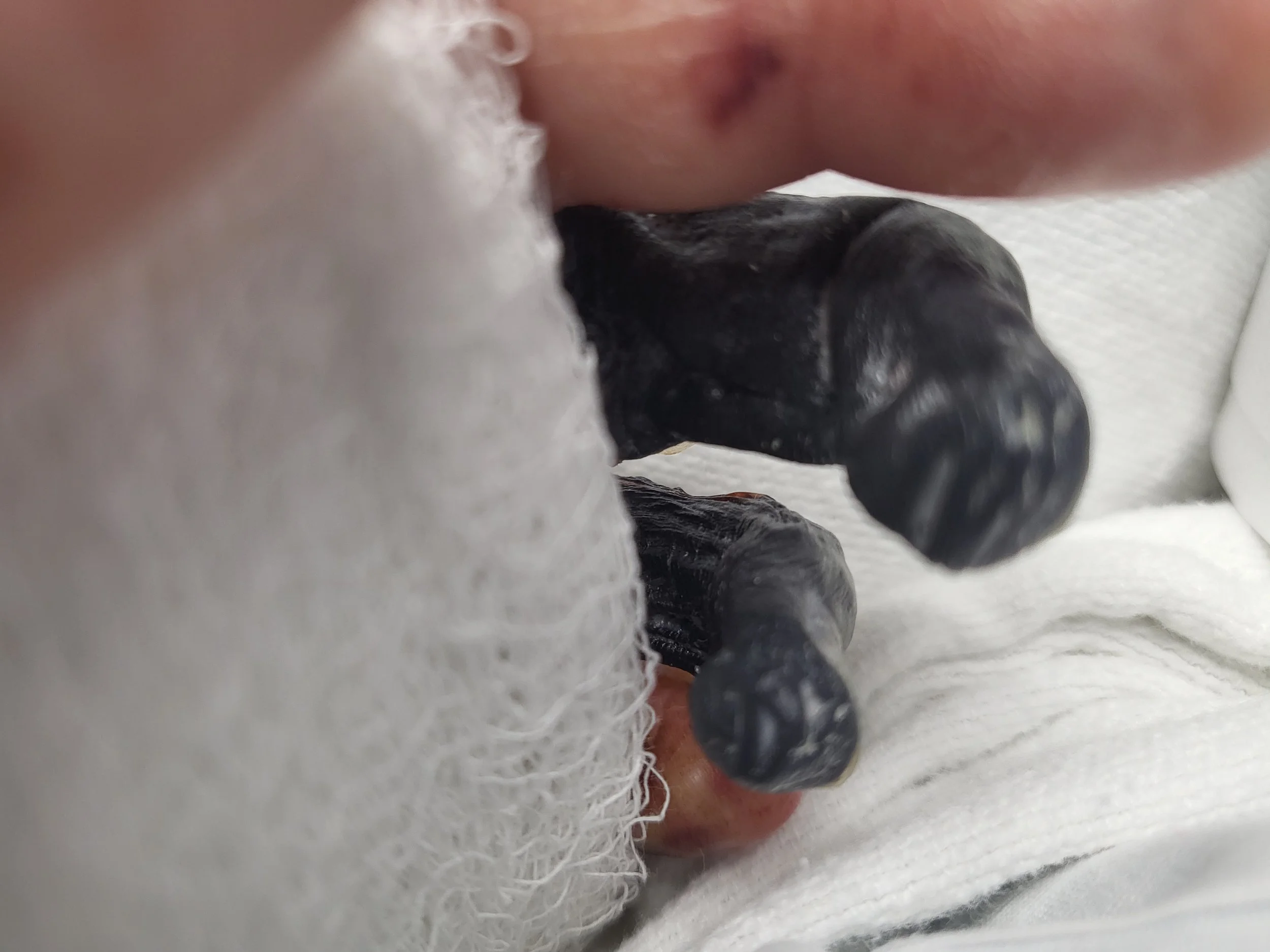 Close-up of my infected fingers, showing why they had to be amputated.