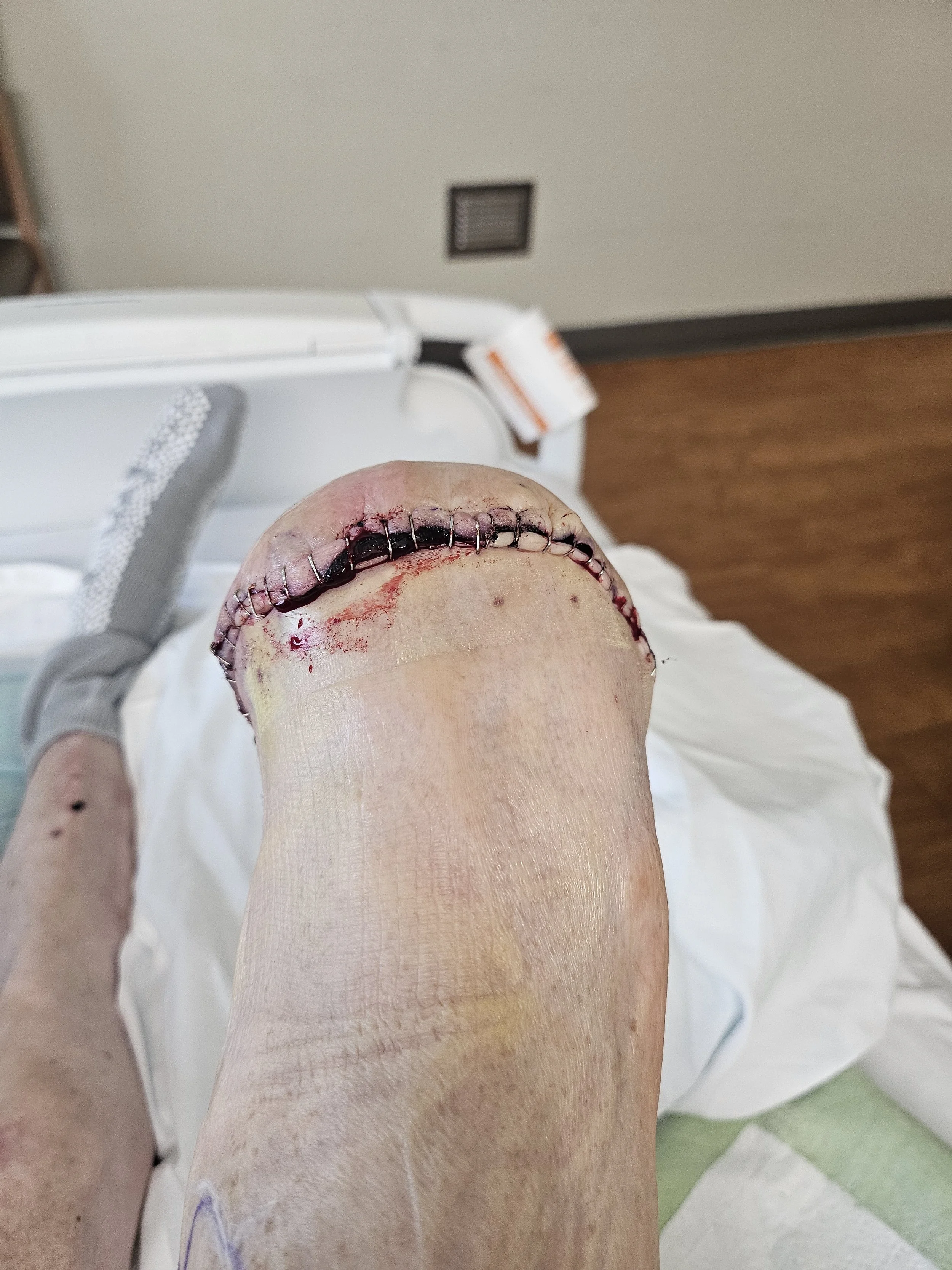 Post-surgery view of a foot with a large surgical incision, stitches, and bandages on the toe, in a hospital bed.