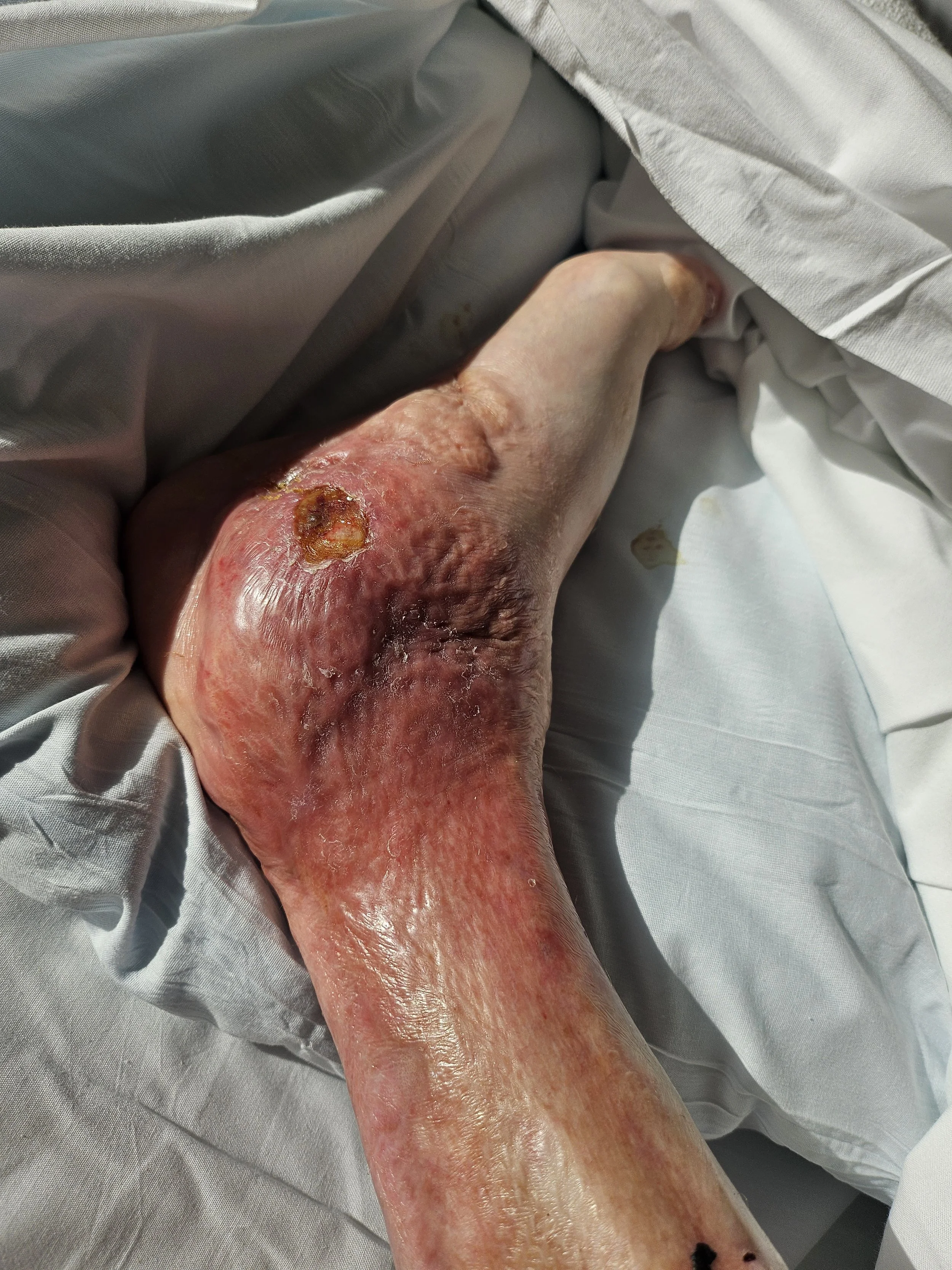 On May 17, I was flexing with Shawn. The very next day, the fun came to a sudden halt when my skin graft became infected.