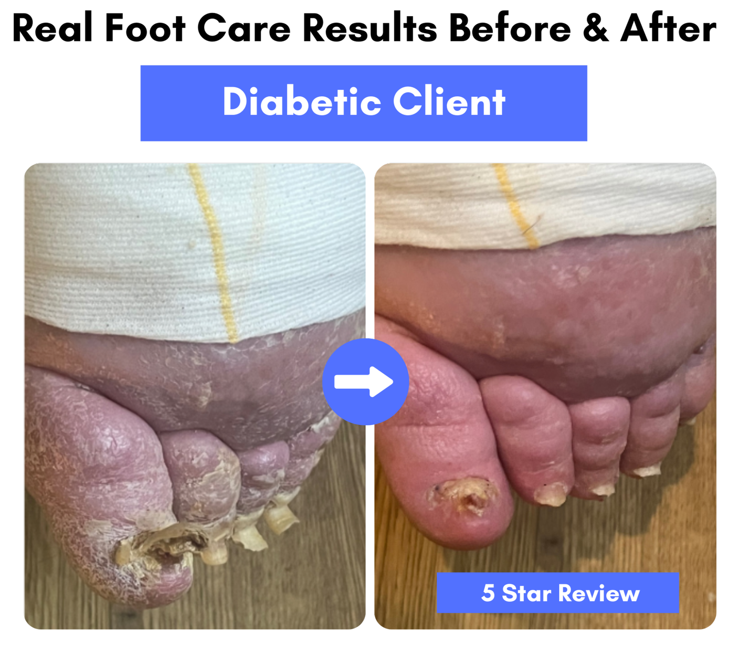 Toenail Cutting Service for Elderly Near Me | Gina Foot Care — Gina ...