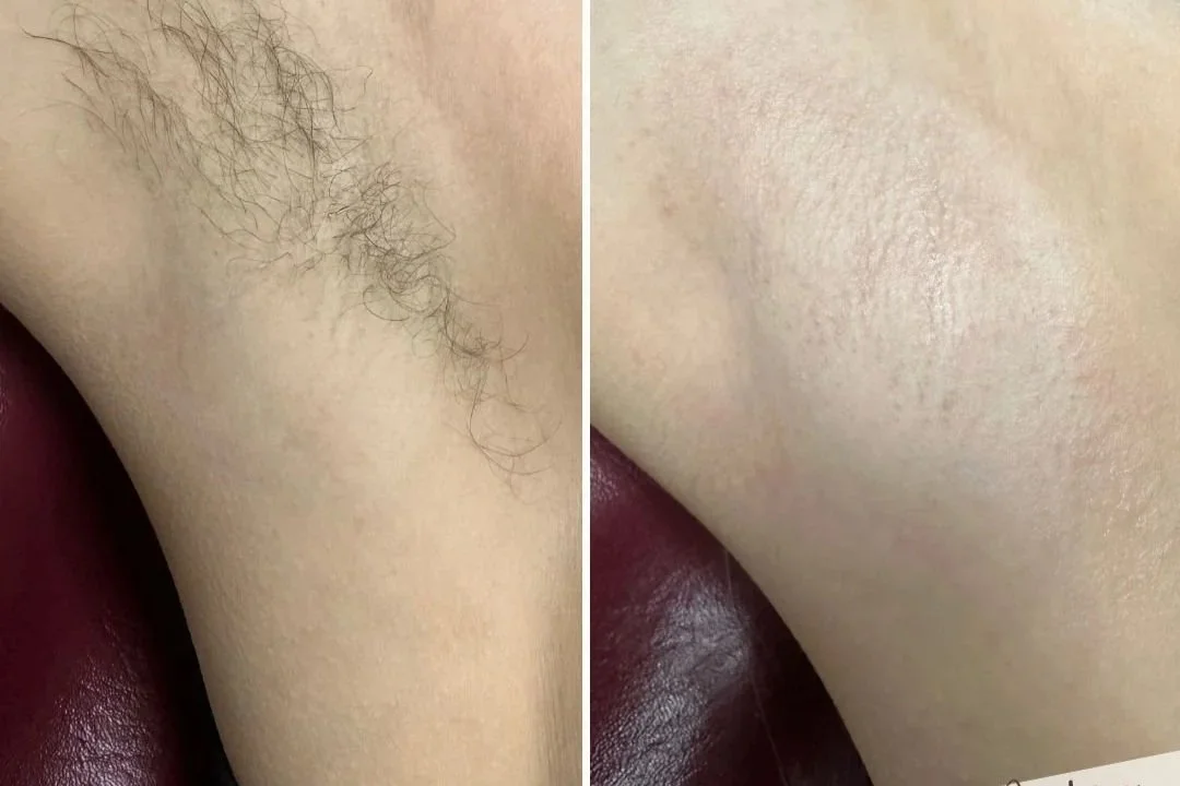 Close-up of a person's underarm showing a before and after comparison, with the left side featuring hair and the right side hairless. This service is done with sugaring or waxing.