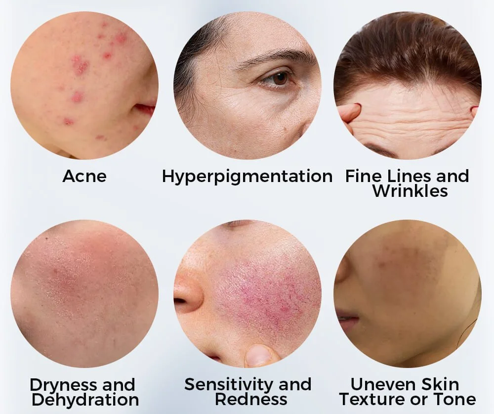 Six close-up images of various skin issues with labels. Top row: acne, hyperpigmentation, fine lines and wrinkles. Bottom row: dryness and dehydration, sensitivity and redness, uneven skin texture or tone.