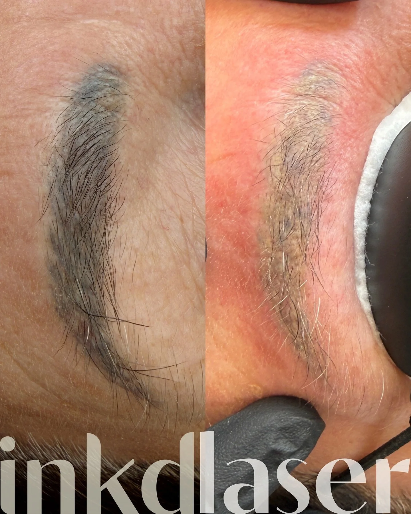 Before ➝ immediately after laser tattoo removal

This photo shows the immediate response after treatment, not the healed result.

Right after laser, pigment can appear much lighter or &ldquo;frosted.&rdquo; This happens because the laser energy creat