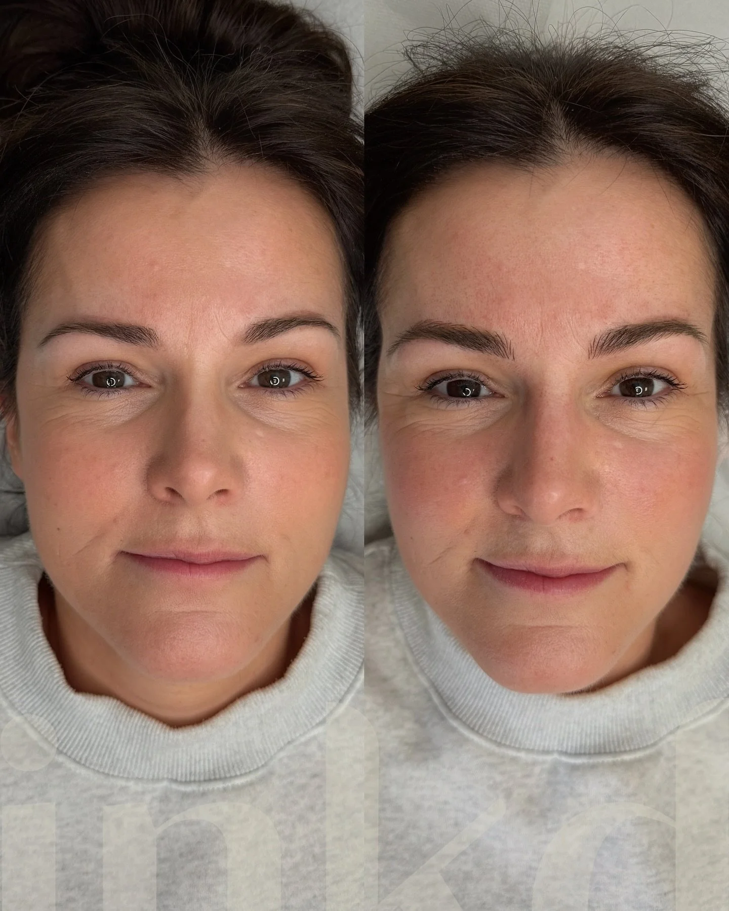 Creating harmony ❤️

M had had her brows done 3 times before, and had residue of carbon black and pink from inorganic pigments in her brow area. This was noticeable at the front of her left brow (before pic) and  across the arch of that brow. The dar
