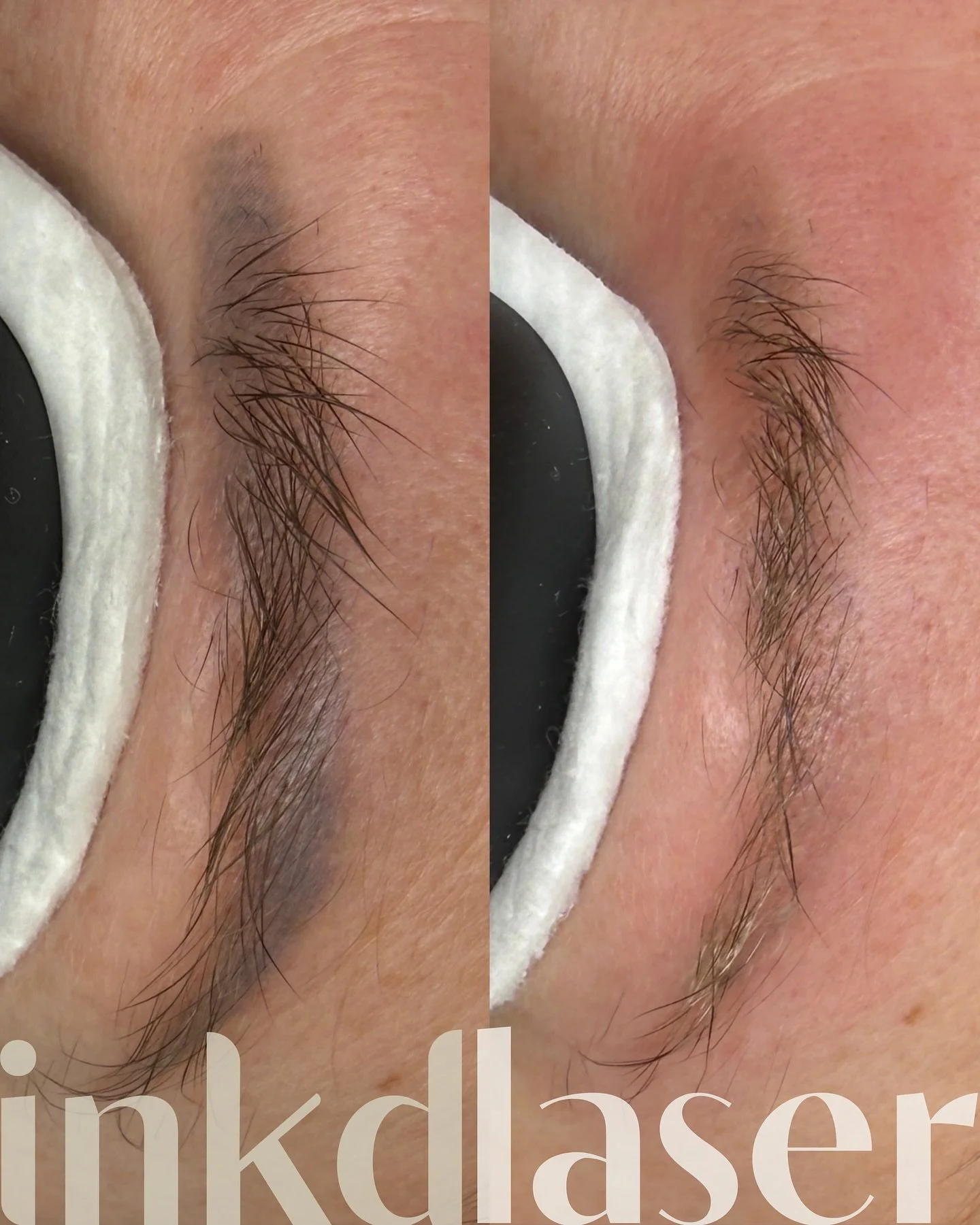 Oh the satisfaction of this one!! 

We&rsquo;ve been trying to get these brows to fade for years!! The curse of the carbon heavy brow daddy era!! 

The good news with your carbon heavy brows is that our Q-Switched ND-YAG laser sees these as a walk in