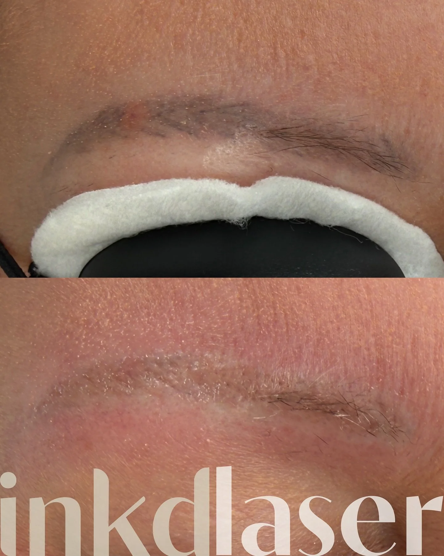 Wow am I excited to redo these 😮&zwj;💨

Once these are off we&rsquo;re going for a realism brow 😍 and I can&rsquo;t wait! 

If you&rsquo;re stuck with brows you don&rsquo;t like, or that won&rsquo;t shift no matter how long you wait, then our lase