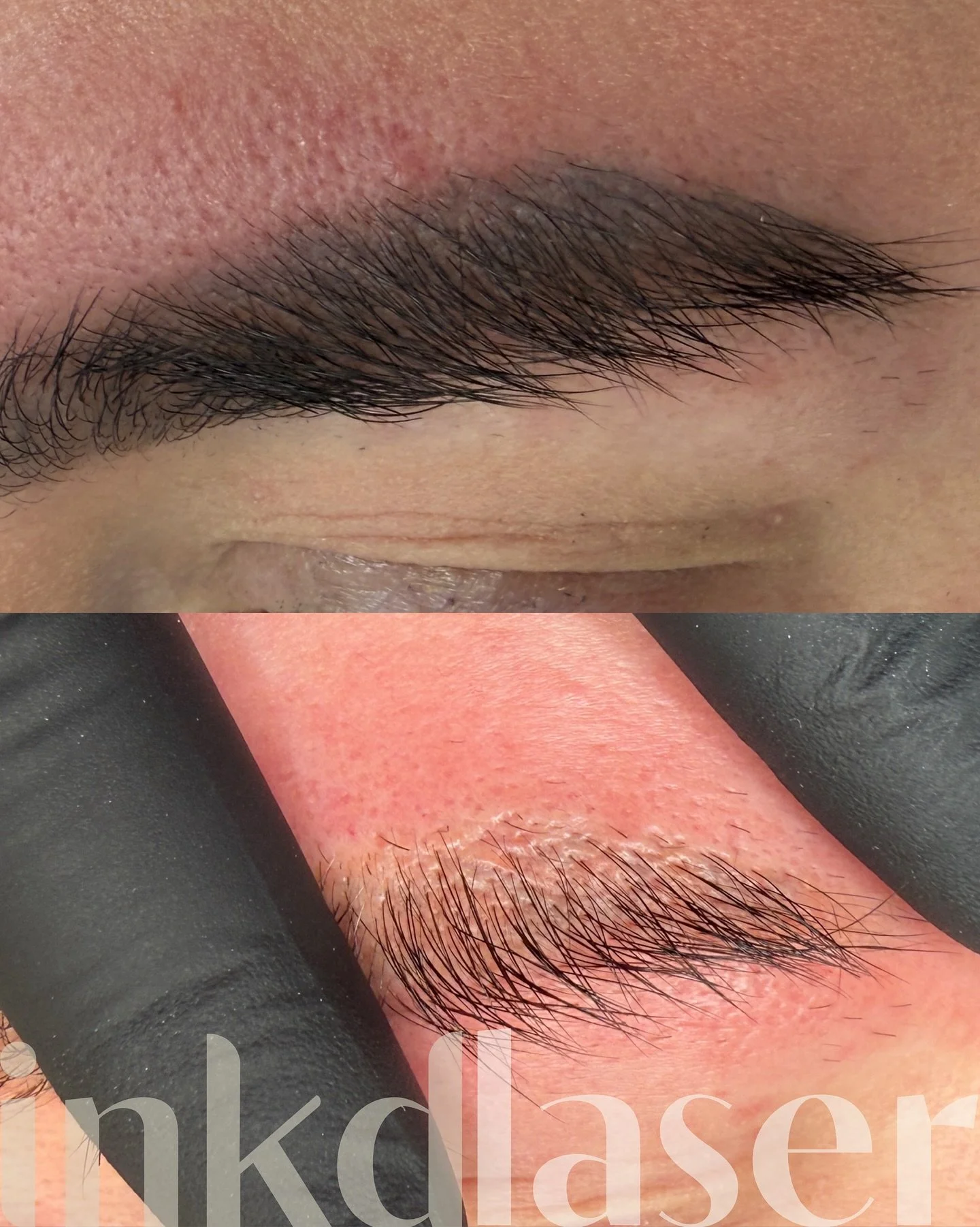 Laser doing its thanggggg ⚡️⚡️

This result is directly after her first session on brows that were just too big for her face! 

No edits obvs 👍🏻

Book your laser patch test here:

Https://inkdlvpl.book.app 

#laserbrowremoval #lasertattooremoval #l