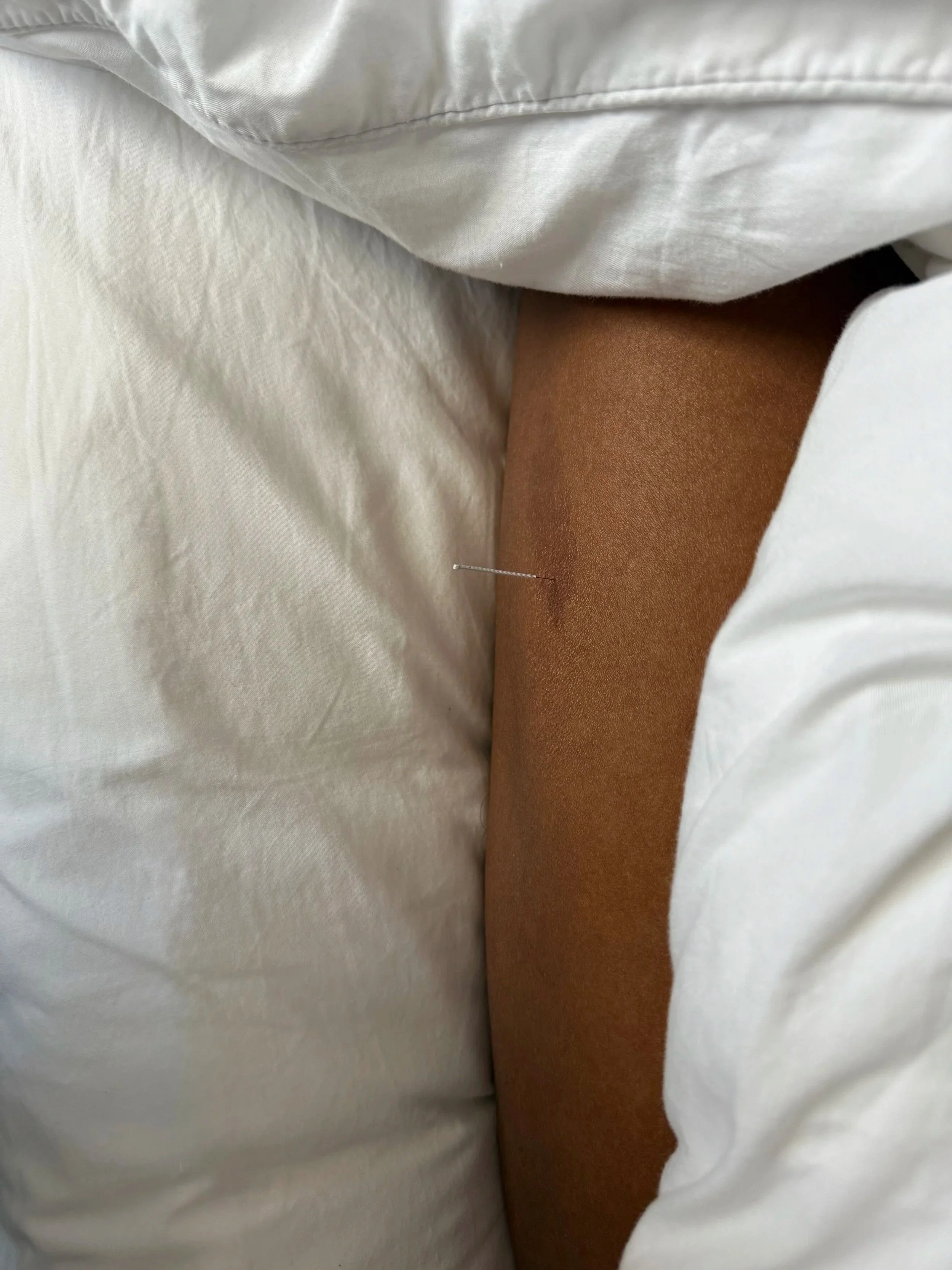 When birthmarks point