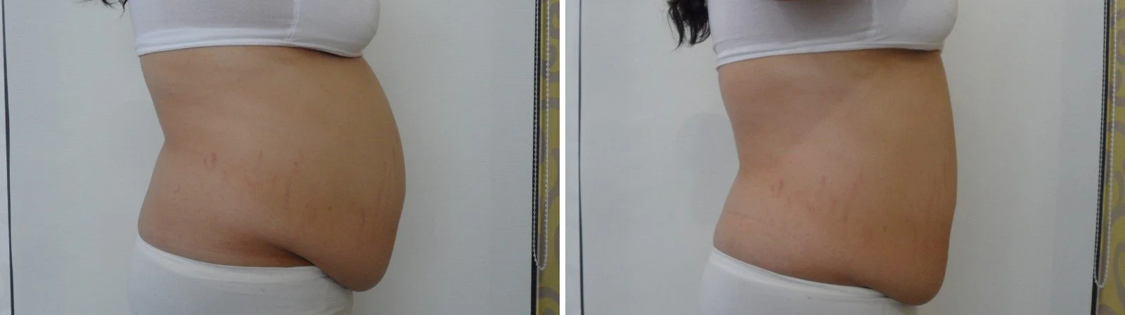 Fat freezing before and after, side view of a flatter stomach and lower belly, fat freezing in Canberra