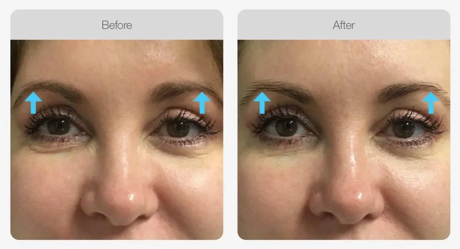 Liftera HIFU before and after, lifted brows and more open eyes, non-surgical brow lift in Canberra