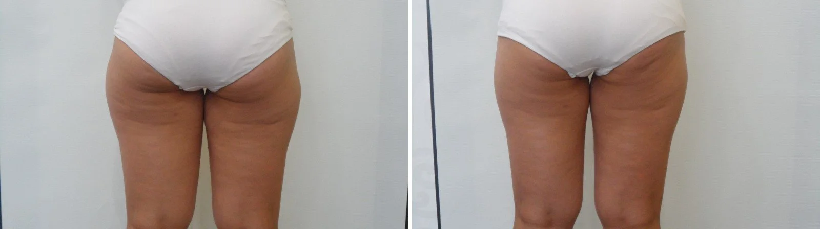 Fat freezing before and after on the back of the thighs, non-surgical thigh fat reduction in Canberra
