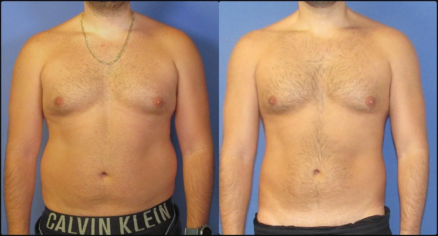 Fat freezing before and after on a man's stomach and chest, non-surgical fat reduction at Harmony Body Contouring Canberra