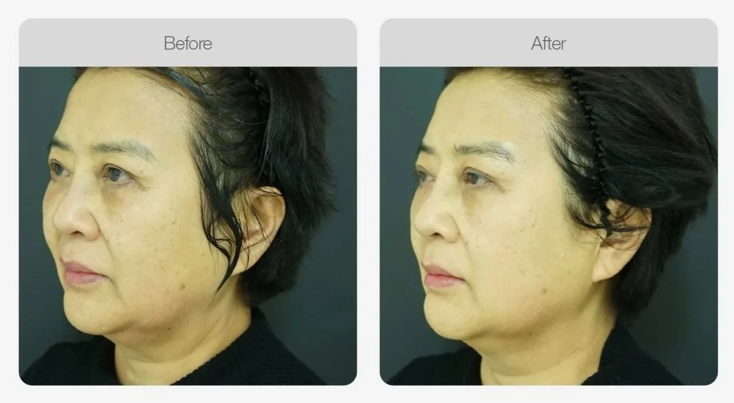 Liftera HIFU before and after, smoother and firmer facial skin, skin tightening in Canberra