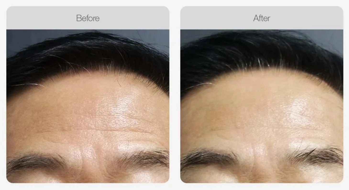 Liftera HIFU before and after, reduced forehead lines and smoother skin, Canberra