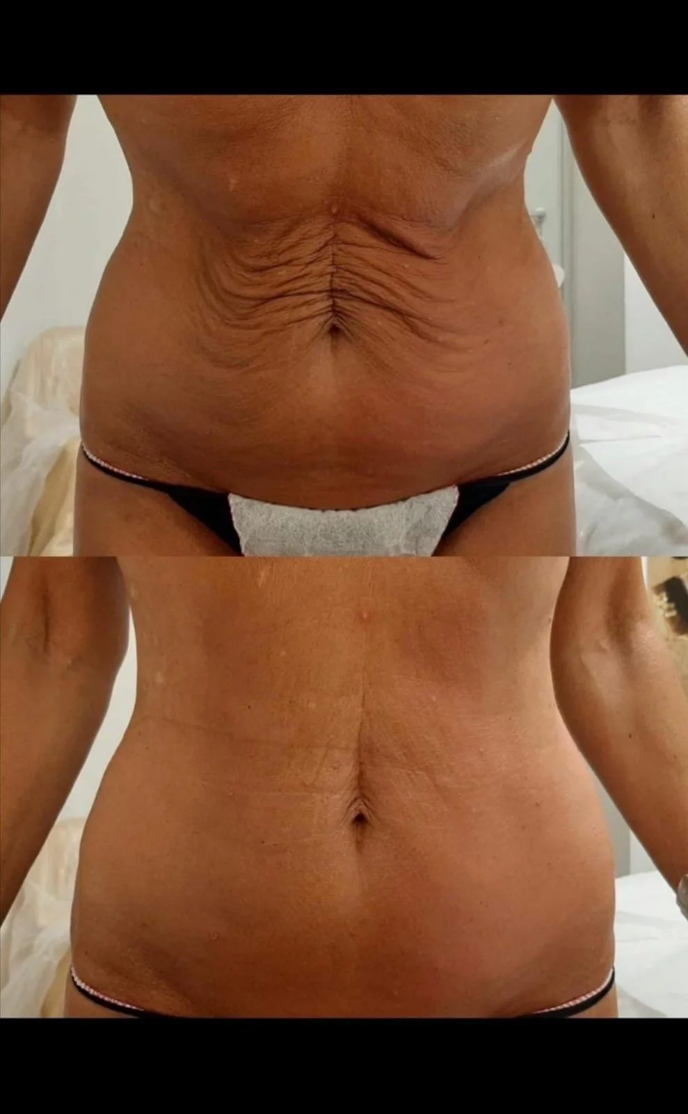 Comparison of a person's abdominal area before and after skin tightening or cosmetic treatment, showing reduced skin looseness and wrinkles