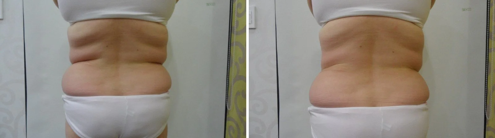 Fat freezing before and after on the back, flanks and love handles, CoolShaping2 fat reduction in Canberra