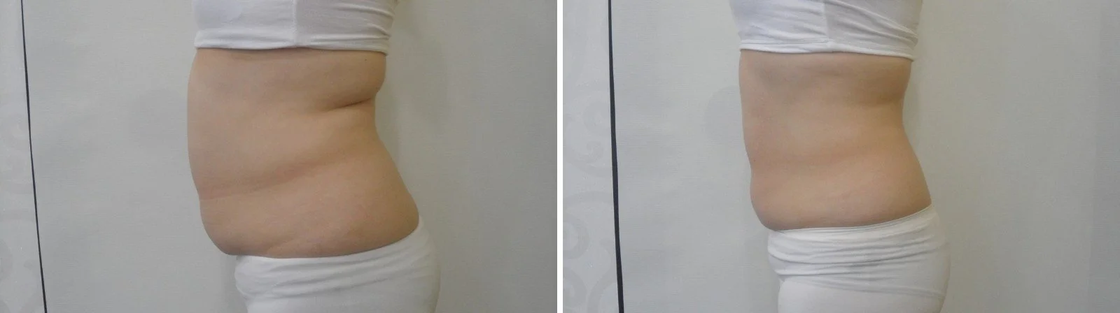 Fat freezing before and after, side view of a slimmer waist and muffin top, body contouring in Canberra