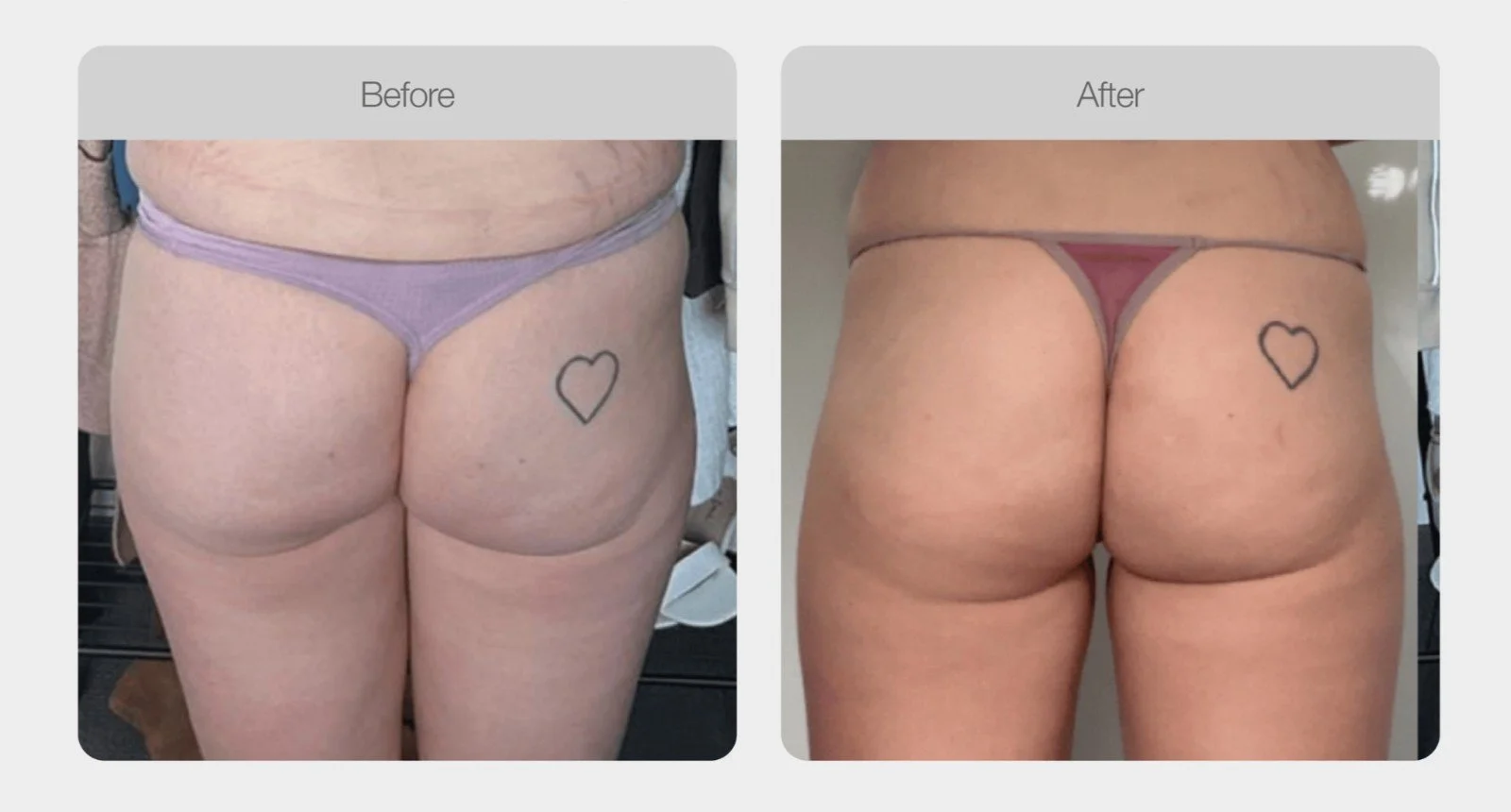 Ultrasound cavitation before and after on the lower back and buttocks, body sculpting in Canberra