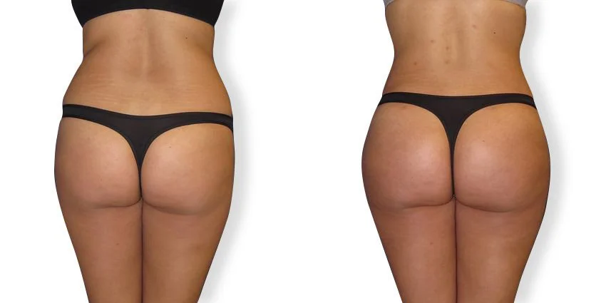 Comparison of a woman's buttocks before and after a cosmetic procedure, with visible enhancement and contouring.