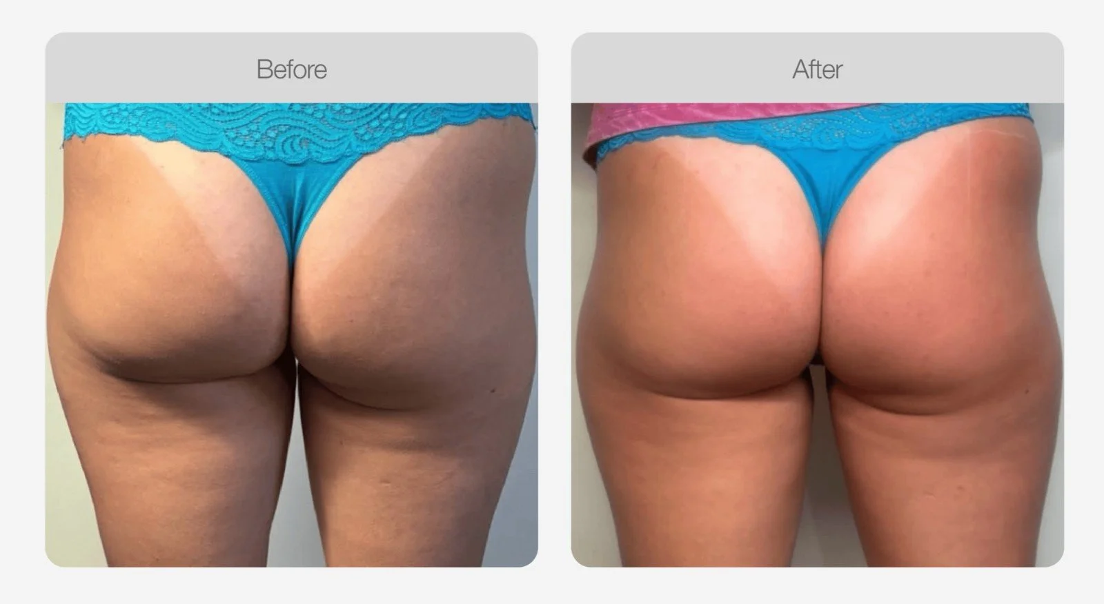 RF skin tightening before and after, firmer and smoother buttocks, Canberra
