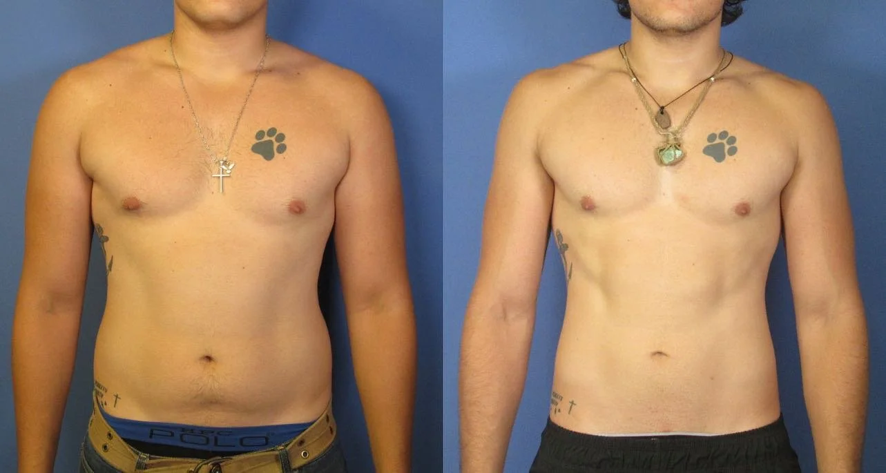 Fat freezing before and after on a man's chest and abdomen, CoolShaping2 treatment at Harmony Body Contouring, Canberra