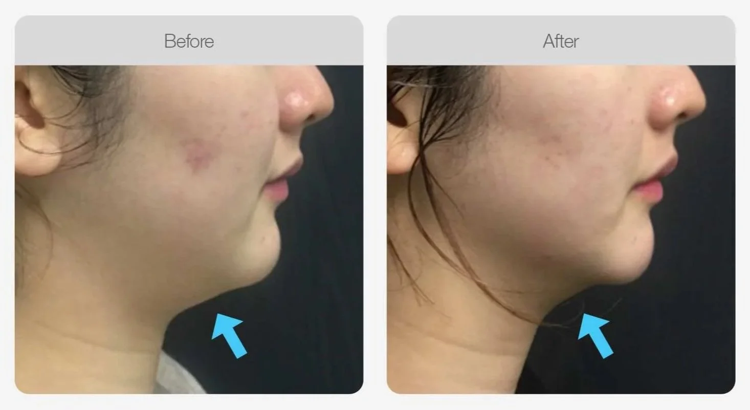 Liftera HIFU before and after, tighter chin and jawline, non-surgical face lifting in Canberra