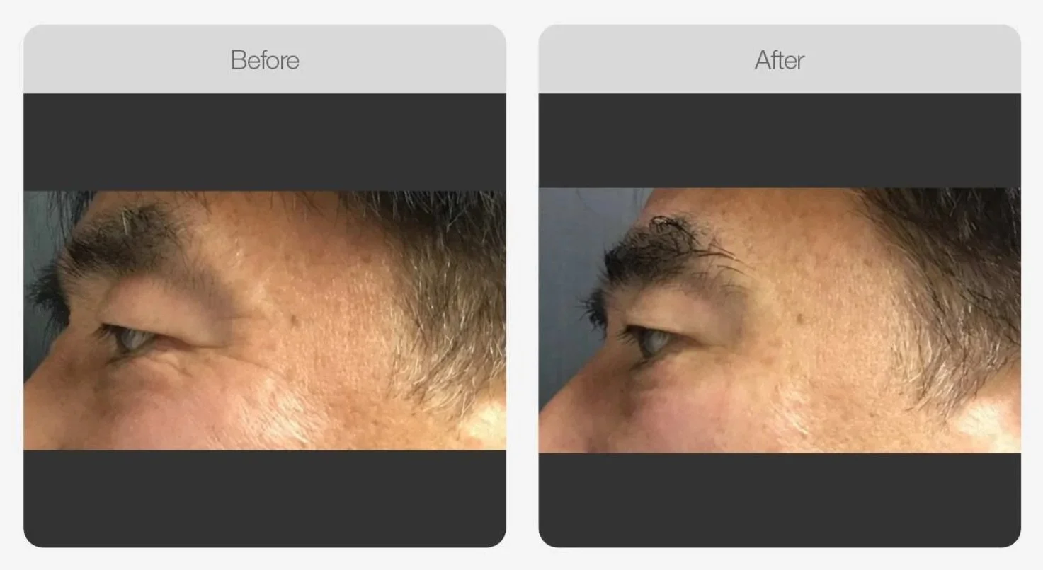 Liftera HIFU before and after on a man's eyebrow area, lifted and firmer skin, Canberra