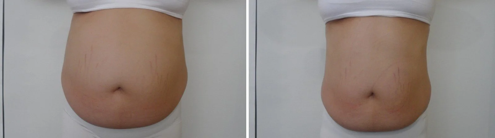 Fat freezing before and after on the stomach, front view, fat reduction at Harmony Body Contouring Canberra